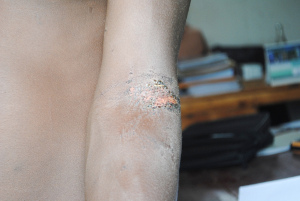 Un jeune homme du nom de T.M. âgé de 21 ans torturé par le chef de colline Karonke en commune de Rumonge ©Iwacu