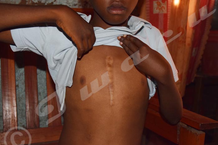 Cette cicatrice en pleine poitrine de Daniel Manirakiza lui rappelle l’intervention  qui lui a sauvé la vie en 2011. 