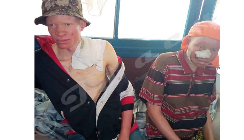 Grande saison sèche : le calvaire des albinos