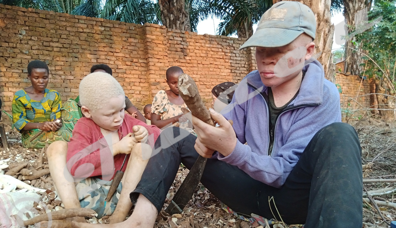 Rumonge : Mères d’enfants albinos, le combat d’une vie